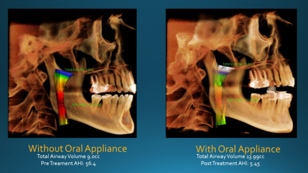 Airway X-Ray without Oral Appliance